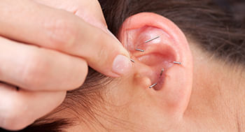 Auriculoterapia